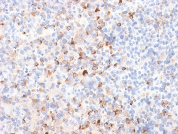 IHC: Formalin-fixed, paraffin-embedded human melanoma stained with recombinant Tyrosinase antibody (clone TYR/2024R). Required HIER: boil tissue sections in 10mM Tris with 1mM EDTA, pH9, or 10mM citrate buffer, pH6, for 10-20 min followed by cooling at RT for 20 min.~