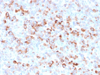 IHC staining of FFPE human Melanoma with recombinant Tyrosinase antibody (clone rOCA1/812). Required HIER: boil tissue sections in 10mM Tris with 1mM EDTA, pH9, or 10mM citrate buffer, pH6, for 10-20 min followed by cooling at RT for 20 min.~