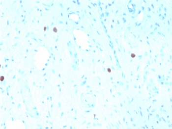 IHC staining of FFPE human cervix with recombinant HPV16 L1 antibody (clone rHPV16L1/1058). Required HIER: boil tissue sections in pH6, 10mM citrate buffer, for 10-20 min followed by cooling at RT for 20 min.~