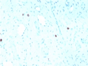IHC staining of FFPE human cervix with recombinant HPV16 L1 antibody (clone rHPV16L1/1058). Required HIER: boil tissue sections in pH6, 10mM citrate buffer, for 10-20 min followed by cooling at RT for 20 min.