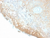 IHC staining of FFPE human cervix with recombinant HPV16 L1 antibody (clone HPV16/2058R). Required HIER: boil tissue sections in pH6, 10mM citrate buffer, for 10-20 min followed by cooling at RT for 20 min.