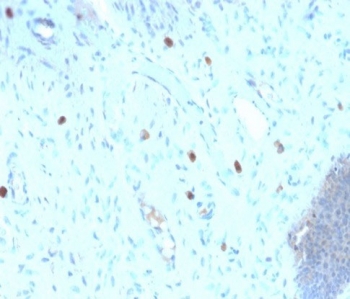 IHC staining of FFPE human cervix with recombinant HPV16 L1 antibody (clone HPV16/2058R). Required HIER: boil tissue sections in pH6, 10mM citrate buffer, for 10-20 min followed by cooling at RT for 20 min.~