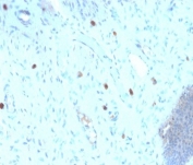 IHC staining of FFPE human cervix with recombinant HPV16 L1 antibody (clone HPV16/2058R). Required HIER: boil tissue sections in pH6, 10mM citrate buffer, for 10-20 min followed by cooling at RT for 20 min.