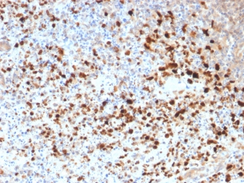 IHC staining of FFPE human cervix with recombinant HSV1 antibody (clone HSV1/1934). Required HIER: boil tissue sections in pH6, 10mM citrate buffer, for 10-20 min followed by cooling at RT for 20 min.~