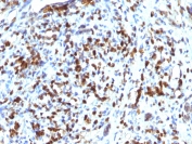 IHC testing of FFPE human Rhabdomyosarcoma with recombinant MyoD antibody (clone MYOD1/2075R). Required HIER: boil tissue sections in 10mM Tris with 1mM EDTA, pH9, for 10-20 min followed by cooling at RT for 20 min.