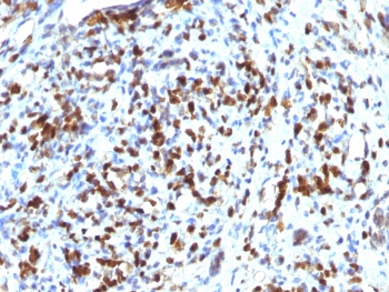 IHC testing of FFPE human Rhabdomyosarcoma with recombinant MyoD antibody (clone MYOD1/2075R). Required HIER: boil tissue sections in 10mM Tris with 1mM EDTA, pH9, for 10-20 min followed by cooling at RT for 20 min.~