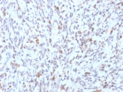 IHC testing of FFPE human Rhabdomyosarcoma with recombinant MyoD1 antibody (clone rMYD712). Required HIER: boil tissue sections in 10mM Tris with 1mM EDTA, pH9, for 10-20 min followed by cooling at RT for 20 min.