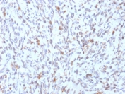 IHC testing of FFPE human Rhabdomyosarcoma with recombinant MyoD1 antibody (clone rMYD712). Required HIER: boil tissue sections in 10mM Tris with 1mM EDTA, pH9, for 10-20 min followed by cooling at RT for 20 min.