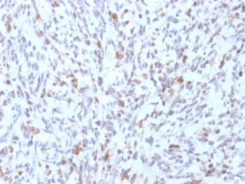 IHC testing of FFPE human Rhabdomyosarcoma with recombinant MyoD1 antibody (clone rMYD712). Required HIER: boil tissue sections in 10mM Tris with 1mM EDTA, pH9, for 10-20 min followed by cooling at RT for 20 min.~