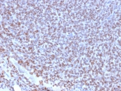 IHC testing of FFPE Ewings sarcoma with recombinant NKX2.2 antibody (clone NX2/2198R). HIER: steam sections in 10mM citrate buffer, pH 6.0, for 10-20 min.