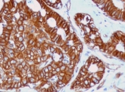 IHC staining of FFPE human breast cancer tissue with recombinant beta Catenin antibody (clone CTNB1-1R). Required HIER: boil tissue sections in 10mM Tris with 1mM EDTA, pH 9, for 10-20 min followed by cooling at RT for 20 min.
