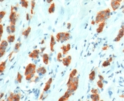 IHC testing of FFPE human breast carcinoma with recombinant MUC1 antibody (clone MCN01-2R). Required HIER: boil tissue sections in pH 9 10mM Tris with 1mM EDTA for 10-20 min followed by cooling at RT for 20 min.