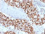 IHC staining of FFPE human colon carcinoma with with Cyclin E1 antibody (clone CCNE1/2460). HIER: boil tissue sections in pH6, 10mM citrate buffer, for 10-20 min followed by cooling at RT for 20 min.
