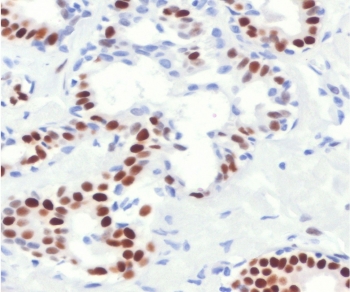 IHC staining of FFPE human breast cancer with Estrogen Receptor alpha antibody (clone NR3Ga-4R). Required HIER: boil tissue sections in pH 9 10mM Tris with 1mM EDTA for 10-20 min followed by cooling at RT for 20 min. ~