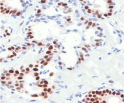 IHC staining of FFPE human breast cancer with Estrogen Receptor alpha antibody (clone NR3Ga-4R). Required HIER: boil tissue sections in pH 9 10mM Tris with 1mM EDTA for 10-20 min followed by cooling at RT for 20 min. 