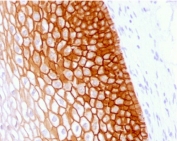 IHC testing of FFPE human cervical squamos cell carcinoma with recombinant CD44v4 antibody (clone CDLA44v4-1R). Required HIER: boil tissue sections in pH6, 10mM citrate buffer, for 10-20 min followed by cooling at RT for 20 min.