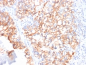 IHC testing of FFPE human renal cell carcinoma with Cadherin 16 antibody (clone CDH16/2125). Required HIER: boil tissue sections in 10mM citrate buffer, pH6, for 10-20 min followed by cooling at RT for 20 min.