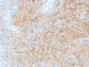 IHC testing of Hodgkin's Lymphoma tissue with CD40 antibody (clone C40/1605). Required HIER: boil tissue sections in 10mM citrate buffer, pH 6, for 10-20 min.