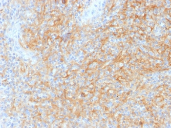 IHC testing of Hodgkin's Lymphoma tissue with CD40 antibody (clone C40/1605). Requi