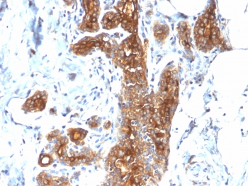 IHC testing of FFPE human breast carcinoma with recombinant Mucin-1 antibody (clone MUC1/2278R). Required HIER: boil tissue sections in pH 9 10mM Tris with 1mM EDTA for 10-20 min followed by cooling at RT for 20 min.~