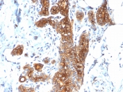 IHC testing of FFPE human breast carcinoma with recombinant Mucin-1 antibody (clone MUC1/2278R). Required HIER: boil tissue sections in pH 9 10mM Tris with 1mM EDTA for 10-20 min followed by cooling at RT for 20 min.