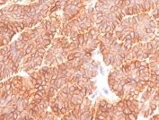 IHC testing of FFPE human basal cell carcinoma and recombinant EpCAM antibody (clone EPM17-5R). Required HIER: boil tissue sections in pH 9 10mM Tris with 1mM EDTA for 10-20 min followed by cooling at RT for 20 min.