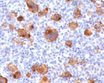 IHC testing of FFPE human Hodgkin's lymphoma with recombinant CD30 antibody (clone rKi-1/779). Required HIER: boil tissue sections in 10mM Tris with 1mM EDTA, pH 9, for 10-20 min followed by cooling at RT for 20 min.~