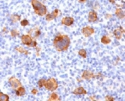 IHC testing of FFPE human Hodgkin's lymphoma with recombinant CD30 antibody (clone rKi-1/779). Required HIER: boil tissue sections in 10mM Tris with 1mM EDTA, pH 9, for 10-20 min followed by cooling at RT for 20 min.