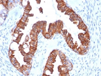 IHC testing of FFPE human endometrial carcinoma with recombinant Cytokeratin 7 antibody (clone rOV-TL12/30). Required HIER: boil tissue sections in 10mM citrate buffer, pH 6, for 10-20 min followed by cooling at RT for 20 min.~
