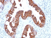 IHC testing of FFPE human endometrial carcinoma with recombinant Cytokeratin 7 antibody (clone rOV-TL12/30). Required HIER: boil tissue sections in 10mM citrate buffer, pH 6, for 10-20 min followed by cooling at RT for 20 min.