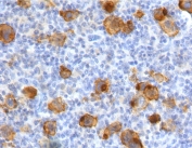 IHC testing of FFPE human Hodgkin's lymphoma with recombinant CD30 antibody (clone CDLA30-2R). Required HIER: boil tissue sections in 10mM Tris with 1mM EDTA, pH 9, for 10-20 min followed by cooling at RT for 20 min.