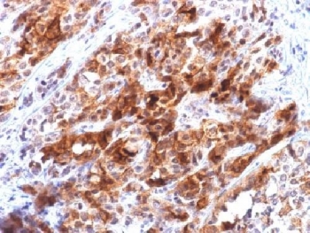 IHC testing of FFPE human hepatocellular carcinoma with recombinant GPC3 antibody (clone rGPC3/863). Required HIER: boil tissue sections in 10mM Tris with 1mM EDTA, pH 9, for 10-20 min followed by cooling at RT for 20 min.~