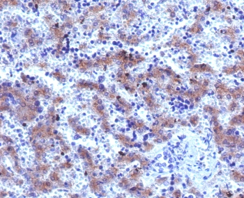 IHC staining of FFPE human hepatocellular carcinoma with Glypican-3 antibody (clone SGPN3-2R). Required HIER: boil tissue sections in 10mM Tris with 1mM EDTA, pH 9, for 10-20 min followed by cooling at RT for 20 min.~