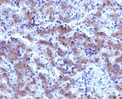 IHC staining of FFPE human hepatocellular carcinoma with Glypican-3 antibody (clone SGPN3-2R). Required HIER: boil tissue sections in 10mM Tris with 1mM EDTA, pH 9, for 10-20 min followed by cooling at RT for 20 min.