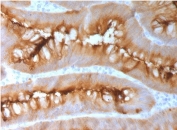 IHC testing of FFPE human melanoma with CEA antibody (clone CCAM5-2R). Required HIER: boil tissue sections in 10mM citrate buffer, pH6, for 10-20 min followed by cooling at RT for 20 min.