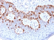 IHC testing of FFPE human melanoma with recombinant Melan-A antibody (clone rMLANA/788). HIER: boil tissue sections in pH 9 10mM Tris with 1mM EDTA for 10-20 min followed by cooling at RT for 20 min.