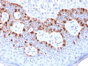 IHC testing of FFPE human melanoma with recombinant Melan-A antibody (clone rMLANA/788). HIER: boil tissue sections in pH 9 10mM Tris with 1mM EDTA for 10-20 min followed by cooling at RT for 20 min.~