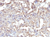 IHC testing of FFPE human histiocytoma with recombinant TNFa antibody (clone TNF/1500R).  Required HIER: steam sections in pH 9 10mM Tris with 1mM EDTA for 10-20 min.