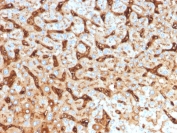 IHC testing of FFPE human hepatocellular carcinoma with Albumin antibody (clone ALB/2144). Required HIER: boil tissue sections in 10mM citrate buffer, pH6, for 10-20 min followed by cooling at RT for 20 min.