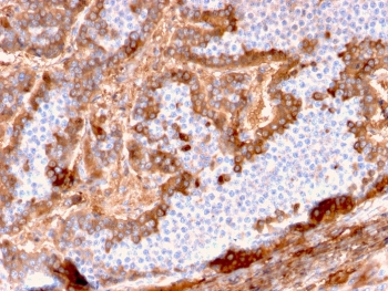 IHC testing of FFPE human hepatocellular carcinoma with Albumin antibody (clone ALB/2144). Required HIER: boil tissue sections in 10mM citrate buffer, pH6, for 10-20 min followed by cooling at RT for 20 min.~
