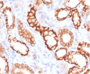 IHC testing of FFPE human renal cell carcinoma with recombinant Cadherin 16 antibody (clone KSCP2-2R). Required HIER: steam sections in 10mM Tris with 1mM EDTA, pH9, for 10-20 min.