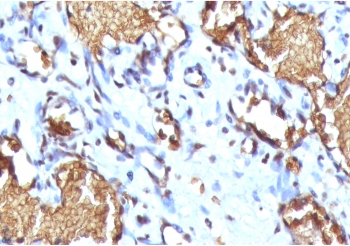 IHC staining of FFPE human angiosarcoma with recombinant Glycophorin A antibody (clone SGPA35-2R). Required HIER: steam section in pH 9 10mM Tris with 1mM EDTA for 20 min and allow to cool prior to staining.~