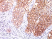 IHC testing of FFPE human lung squamous cell carcinoma with EGF Receptor antibody (clone GFR/1667). HIER: boil tissue sections in pH 9 10mM Tris with 1mM EDTA for 20 min and allow to cool before testing.