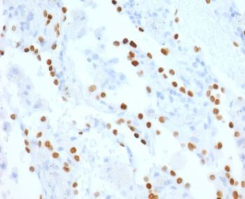IHC staining of human lung adenocarcinoma with recombinant NKX2.1 antibody (clone HBNK2-2R). Required HIER: boil tissue sections in pH6, 10mM citrate buffer, for 10-20 min followed by cooling at RT for 20 min.~