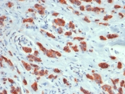IHC testing of FFPE human breast carcinoma with recombinant Mucin-1 antibody (clone MUC1/1887R). Required HIER: boil tissue sections in pH 9 10mM Tris with 1mM EDTA for 10-20 min followed by cooling at RT for 20 min.
