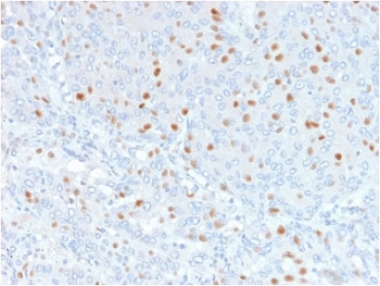 IHC testing of FFPE human bladder carinoma with Annexin A1 antibody (clone 6E4/3). HIER: boil tissue sections in pH6, 10mM citrate buffer, for 10-20 min followed by cooling at RT for 20 min.~