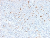 IHC testing of FFPE human bladder carinoma with Annexin A1 antibody (clone 6E4/3). HIER: boil tissue sections in pH6, 10mM citrate buffer, for 10-20 min followed by cooling at RT for 20 min.