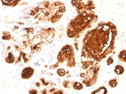 IHC testing of FFPE human ovarian carcinoma with recombinant MUC-1 antibody (clone rMUC1/960). Required HIER: boil sections in pH 9 10mM Tris with 1mM EDTA for 10-20 min.
