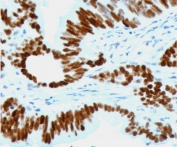 IHC staining of FFPE human colon carcinoma with recombinant p53 antibody (clone CTA53-2R). Required HIER: boil tissue sections in pH6, 10mM citrate buffer, for 10-20 min followed by cooling at RT for 20 min.
