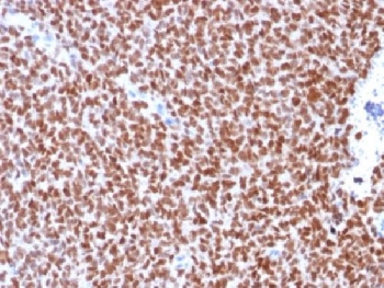 IHC testing of Ewing's sarcoma stained with recombinant NKX2.2 antibody (clone rNX2/294). Required HIER: boil tissue sections in 10mM citrate buffer, pH 6, for 10-20 min followed by cooling at RT for 20 min.~